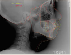 初診時・動的治療後のセファロ重ね合わせによる比較