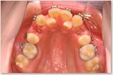 動的治療開始時　上顎