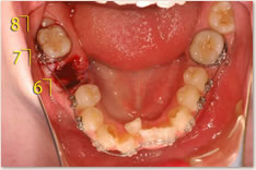 動的治療中に右下６番を抜歯