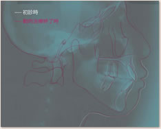 初診時・動的治療後のセファロ重ね合わせによる比較