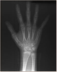 手根骨のＸ線写真