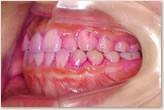 歯周組織検査　左側