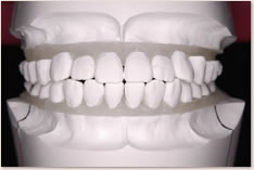非抜歯矯正治療の予測模型（白）：正面
