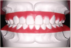 抜歯矯正治療の予測模型（赤）：正面