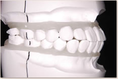 非抜歯矯正治療の予測模型（白）：右側