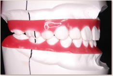 抜歯矯正治療の予測模型（赤）：右側