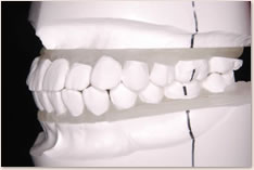 非抜歯矯正治療の予測模型（白）：左側