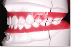 抜歯矯正治療の予測模型（赤）：左側