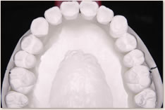 非抜歯矯正治療の予測模型（白）：上顎