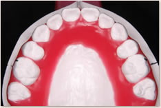 抜歯矯正治療の予測模型（赤）：上顎