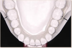 非抜歯矯正治療の予測模型（白）：下顎
