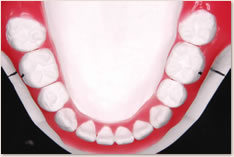 抜歯矯正治療の予測模型（赤）：下顎