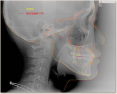 初診時・動的治療後のセファロ重ね合わせによる比較