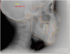 初診時・動的治療後のセファロ重ね合わせによる比較