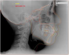 初診時・動的治療後のセファロ重ね合わせによる比較