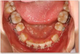 再評価時（動的治療開始から７ヵ月後）　下顎