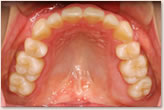 動的治療後　上顎