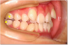 初診時:上顎の第１大臼歯近心頬側咬頭(▼)が下顎第１大臼歯頬面溝（▲）に対して近心（前方）に位置するAngle class IIを呈している