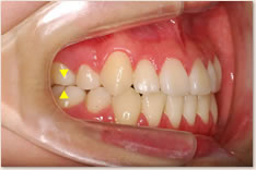 動的治療終了時:上顎の第１大臼歯近心頬側咬頭(▼)と下顎第１大臼歯頬面溝（▲）が一致するAngle class I（理想的な臼歯の位置関係）を呈している