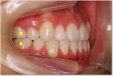 保定完了時:動的治療終了時と同様に上顎の第１大臼歯近心頬側咬頭(▼)と下顎第１大臼歯頬面溝（▲）が一致するAngle class I（理想的な臼歯の位置関係）を維持している