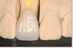 上顎右側1番のセラミック補綴物（制作時）