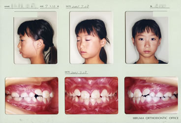 2001年7歳10ヵ月　初診時の顔貌および口腔内写真