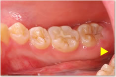 上顎左側第2大臼歯
