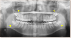 パノラマＸ線写真:▲親知らずが埋伏しています