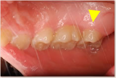 上顎右側第２大臼歯