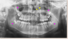 パノラマＸ線写真:▲親知らずの埋伏 ▼上顎左側2、3番の埋伏