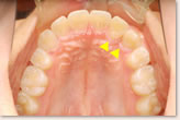 動的治療後　上顎