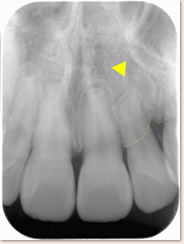 パノラマＸ線写真:▲上顎左側2番の根尖が湾曲していることがわかります