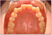 動的治療開始時　上顎
