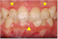 ▲	プラークが蓄積して歯肉炎が起きている上下顎前歯