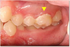 ▲	鋏状咬合によりプラークが蓄積している上顎左側６番