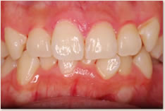 再評価時（初期治療後）の上顎前歯