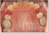 動的治療開始時　上顎