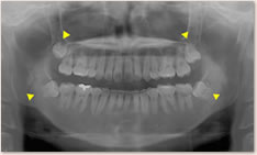 パノラマＸ線写真:▲	萌出してきた第３大臼歯（親知らず）