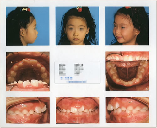 7歳～8歳：前歯のでこぼこ（叢生）