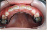 A歯科医院にて（7歳～8歳）　上顎