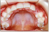 B歯科医院に転医時（8歳～10歳）　上顎
