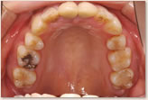 動的治療終了時　上顎
