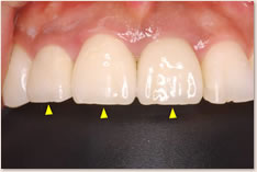 上顎右側２番、左右１番のクラウン装着時