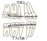 キャナイン　リトラクション