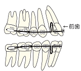 アンテリア　リトラクション開始